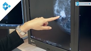 Brustdiagnostik  Knoten frühzeitig erkennen [upl. by Nylcaj875]