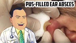 PusFilled Ear Abscess Drained  Revisited Popping [upl. by Zeus625]