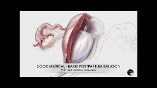 Cook Medical  Bakri Balloon Postpartum with rapid instillation components [upl. by Eseuqram812]