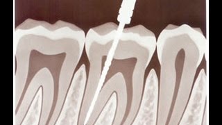 Recomendaciones y complicaciones tras una endodoncia [upl. by Teague600]