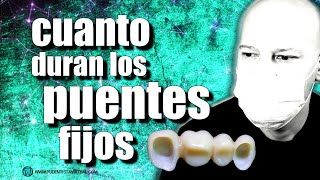 🔵PROBLEMAS con los PUENTES FIJOS sin IMPLANTES [upl. by Simmonds]