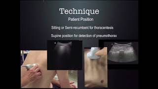 US Guided thoracentesis CUSE 2018 [upl. by Monroe]