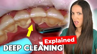 Dental Hygienist Explains Deep Cleaning Procedure [upl. by Idnek]