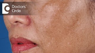 Treatment of Melasma  Dark Spots on Face  Dark patch on face  Dr Satish D A  Doctors Circle [upl. by Latsyek]