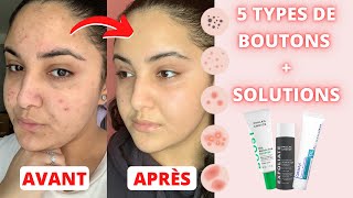 LACNÉ  MA ROUTINE SKINCARE  TOUTES LES SOLUTIONS POUR CHAQUE TYPE DE BOUTON [upl. by Neva]