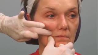 Lifting Mouth Corners amp Filling Marionette Lines With Dermal Filler [upl. by Aserahs]