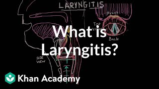 How to manage of Laryngitis  Dr Sriram Nathan [upl. by Sharron876]