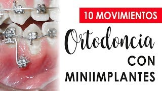 10 MOVIMIENTOS CON MINIIMPLANTES  ORTODONCIA [upl. by Nickolai889]