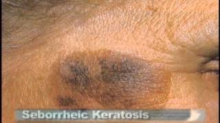 Common Skin Lesions [upl. by Ajani]