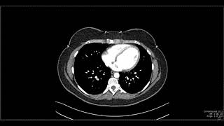 Abdominal Anatomy on Computed Tomography [upl. by Skricki]