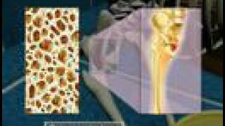 Osteoporosis3D Medical Animation [upl. by Hulda]