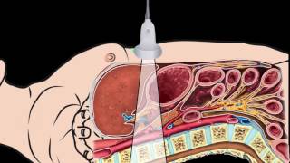 Introduction Abdominal Aorta Focused Ultrasound Examination [upl. by Claudy]