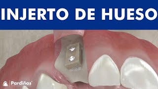 INJERTOS de HUESO para REGENERACIÓN en IMPLANTES DENTALES  Bloque y particulado © [upl. by Gardy]