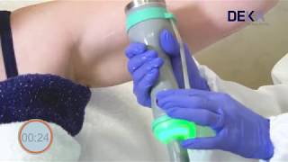 ONDA by DEKA  Tightening Treatment Tutorial [upl. by Parks]