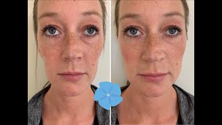 Juvederm Voluma Cheek Filler Treatment  Before  After  Nashville PA [upl. by Essiralc163]