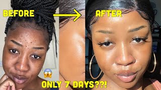 HOW I CLEARED MY SKIN in 1 WEEK and LIGHTENED my dark under eye circles [upl. by Maclean]