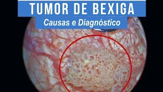 Tumor de Bexiga  Causas e Diagnóstico [upl. by Suzie]