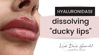 Dissolving Lip Filler [upl. by Dachy]