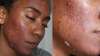 GREEN PEEL Full Process  Procedure Peeling Before amp After NO CHEMICAL PEEL [upl. by Ettenig]