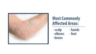 Hidradenitis Suppurativa HS  Pathophysiology Triggers Signs amp Symptoms Diagnosis Treatment [upl. by Wertz]