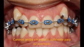 CASO ORTODONCIA MINIIMPLANTES DISTALIZACION MOLARES [upl. by Arataj]