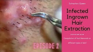 Infected Ingrown Hair Removal  Episode 2 [upl. by Eninaj]