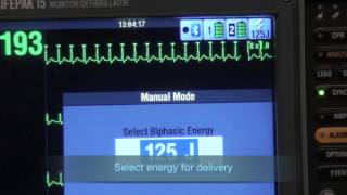 Synchronized Cardioversion [upl. by Yeloc]