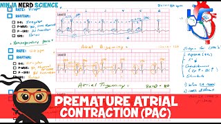 Rate and Rhythm  Premature Atrial Contraction PAC [upl. by Aicekan991]